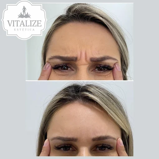 Registro de antes e depois de Botox